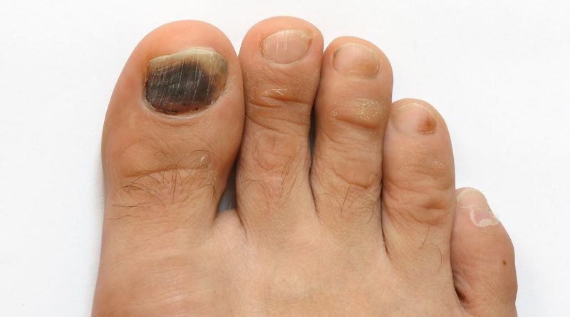 Natural Remedies For Onychomycosis Nail Fungus Go Lifestyle Wiki