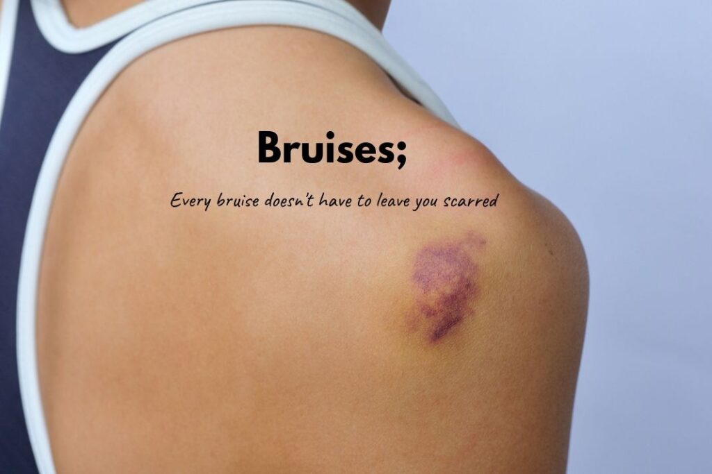 Bruises