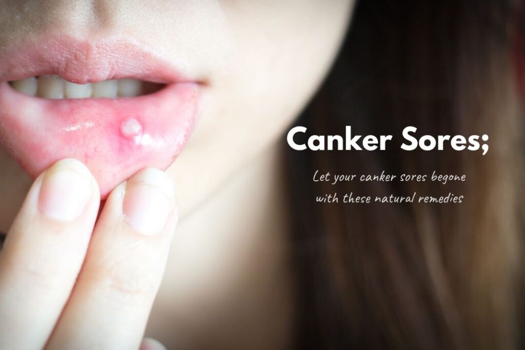 Canker Sores