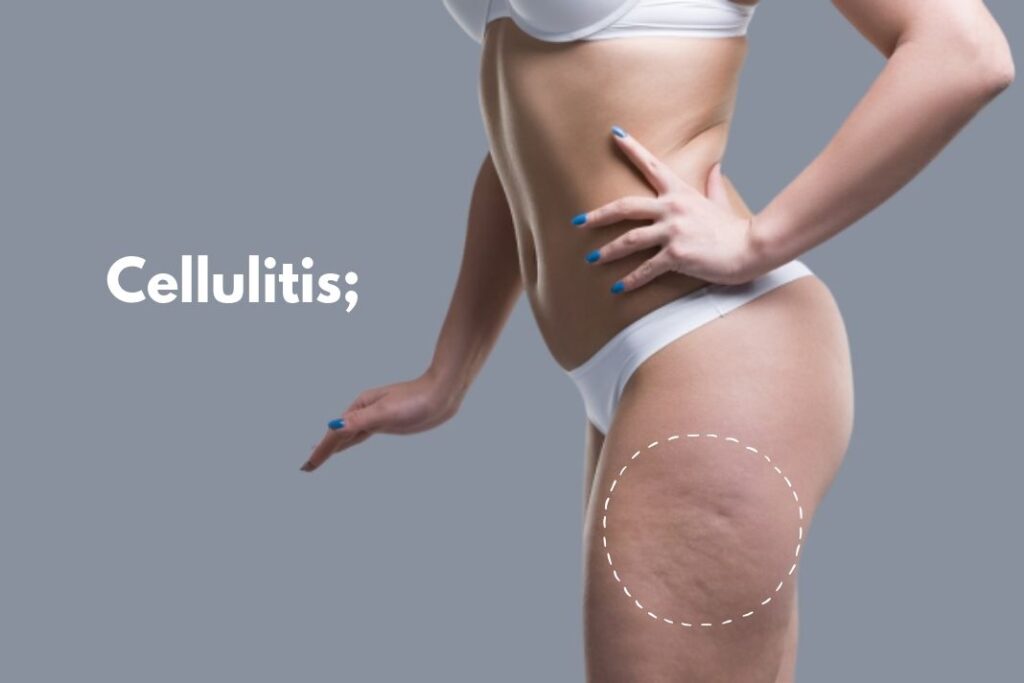 Cellulitis