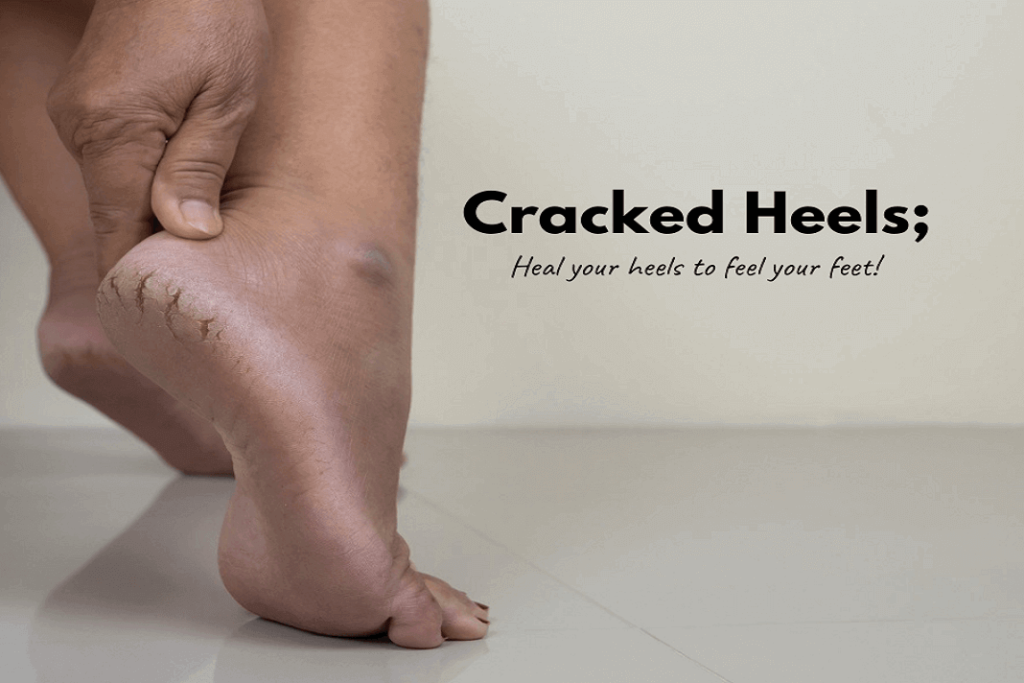 Cracked Heels