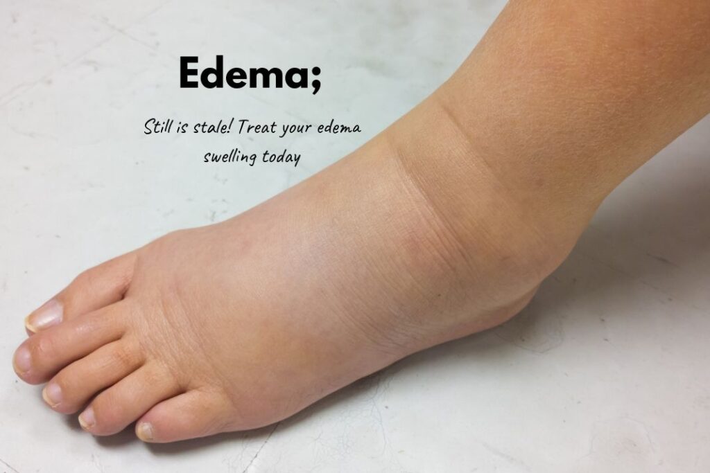 Edema