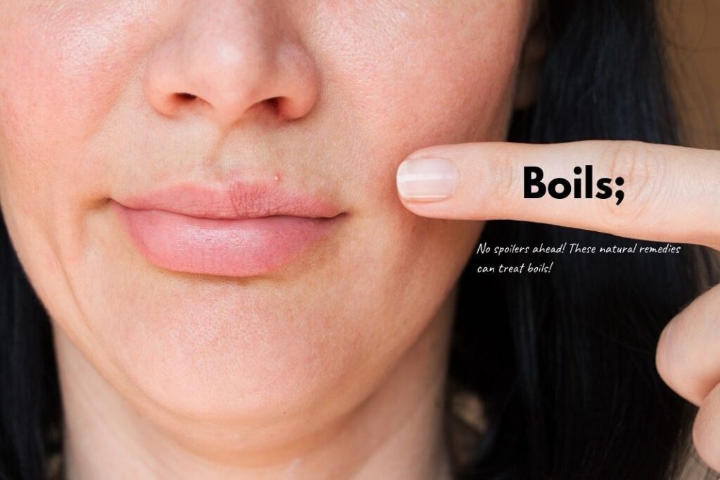 Get Rid Of Boils