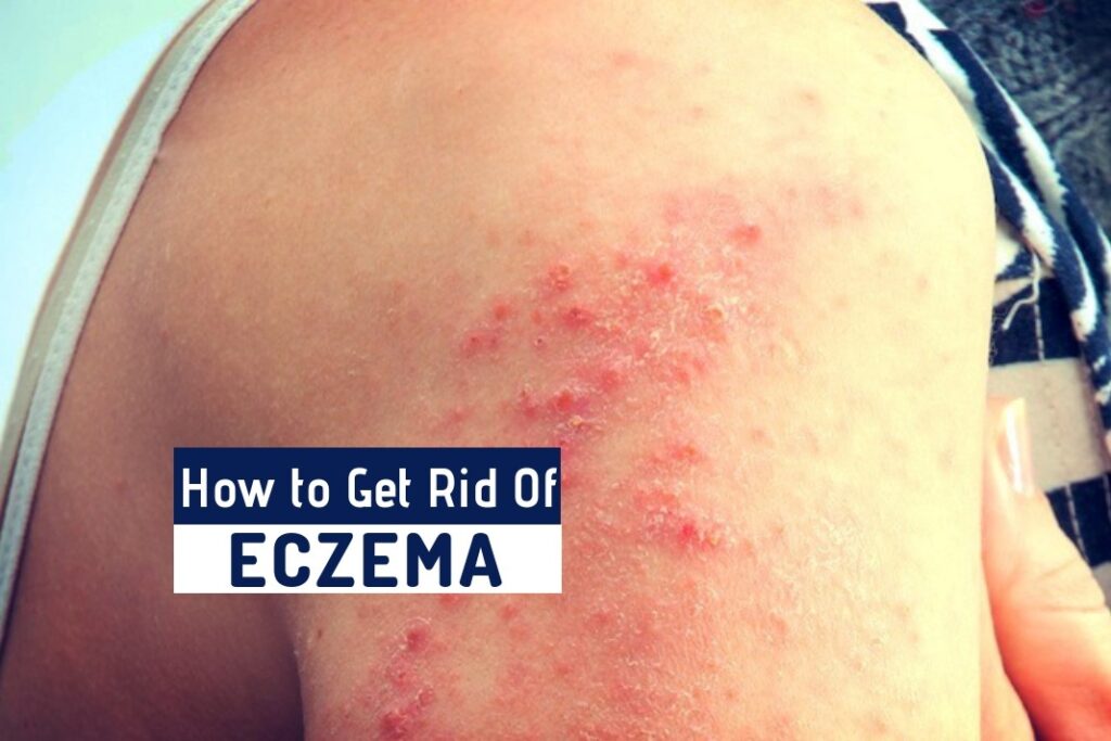 How to Get Rid of Eczema