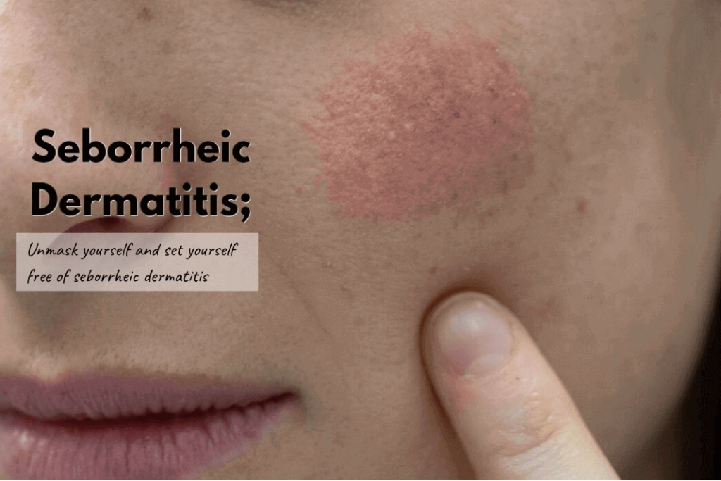 Seborrheic Dermatitis